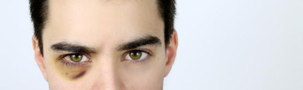 Is A "Black Eye" Serious?