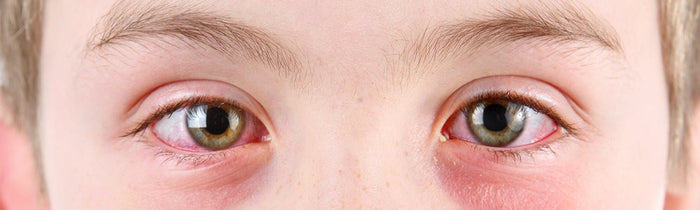 Pink Eye (Conjunctivitis) Symptoms, Treatments And Prevention